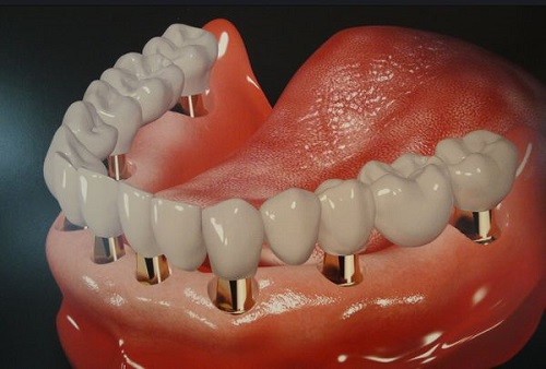 种植牙会对牙床造成损坏吗