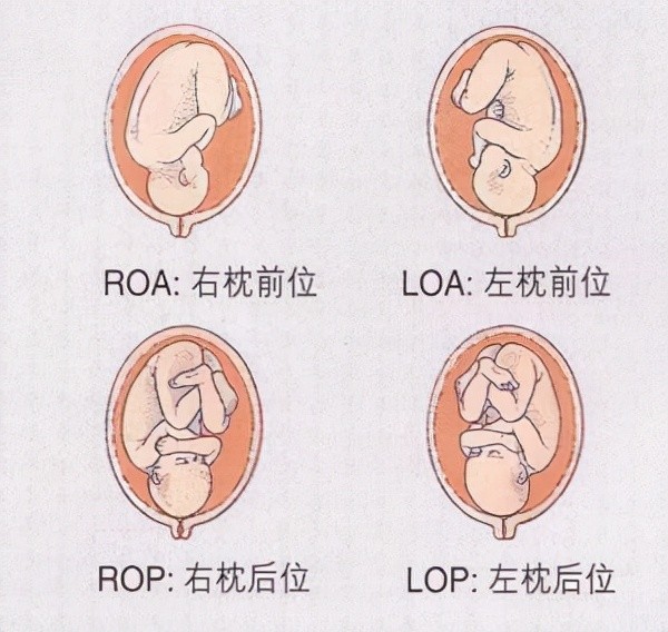 LOA胎位图图片