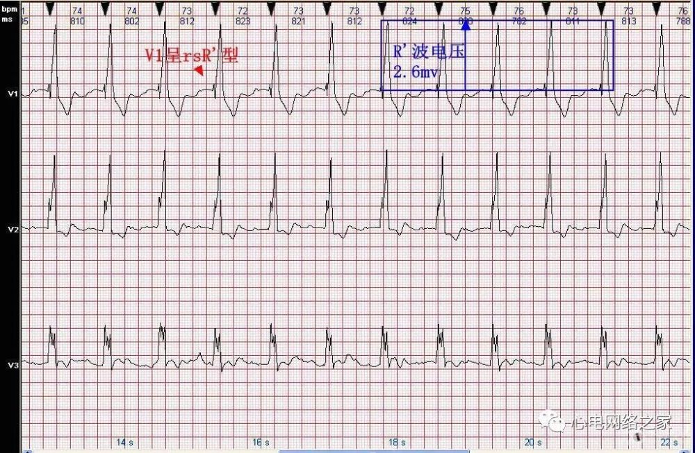 心電圖病例分析48完全性右束支阻滯合併左前分支阻滯伴i度房室傳導