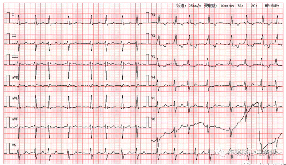 每日读图第1632期间位性室性早搏呈三联律