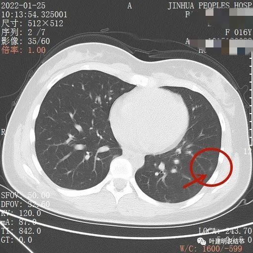 1.26):16歲花季少女的肺結節