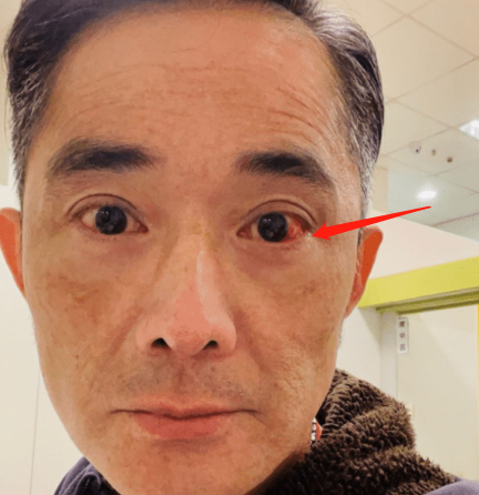 令人擔憂54歲男星眼球血管破裂一個月出血3次曾說終身不娶