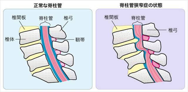 走著走著腿沒勁還疼是人老了老年人腰椎管狹窄怎麼治療好