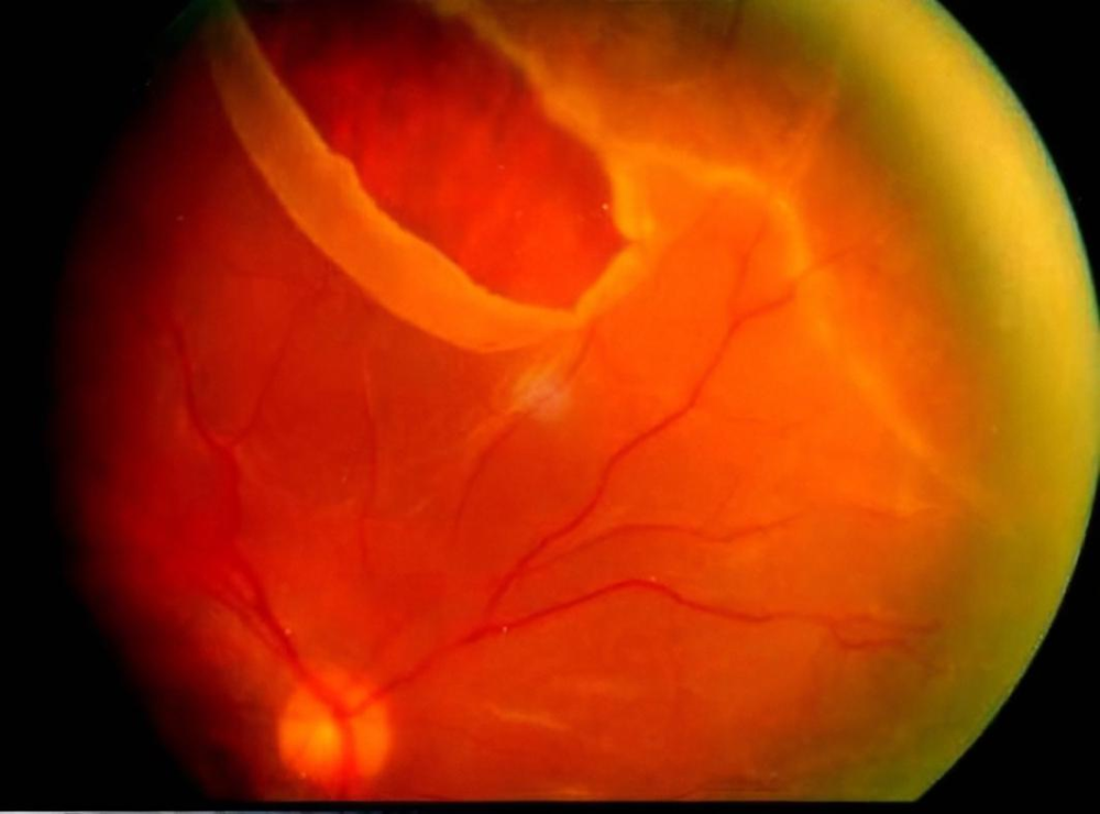 眼底"裂了个洞",小心黄斑裂孔!50岁以上的老年妇女高发_腾讯新闻