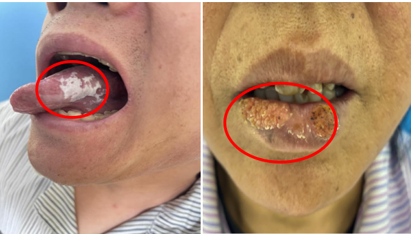 迎春节,送健康|哈医大一院口腔专家提示:别小看口腔溃烂,要小心"口腔