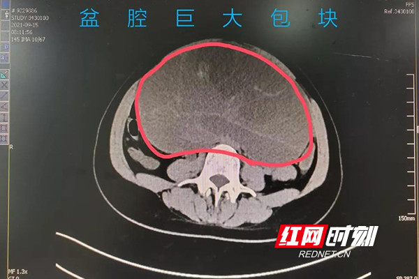 24岁女性盆腔查出巨大包块 这类疾病治疗一定要趁早