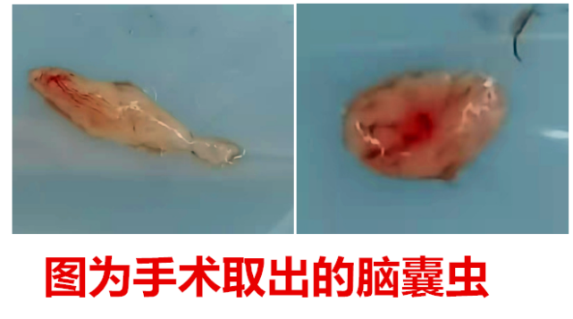 脑积水|脑室|脑囊虫病|头痛|医生|医院