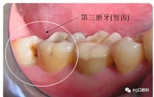 需要注意的是,無論智齒是否萌出,如果不認真使用牙刷,牙線清潔牙齒,沒