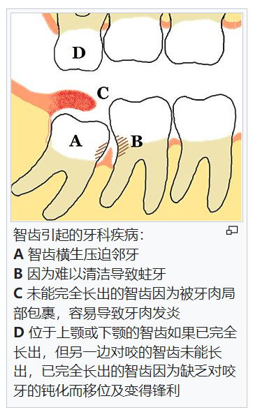 年度征文|你的智齿,还要留着过几个年?