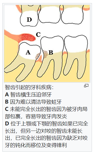 年度徵文|你的智齒,還要留著過幾個年?