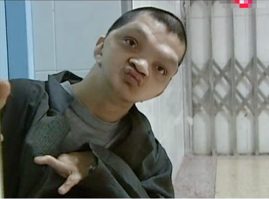 狭颅症,长相似猿猴智力低下,医生也无奈摇头|湖南|陈聪华|陈聪生|猴人