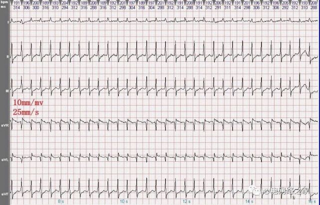 心电图病例分析49:慢快型房室结折返性心动过速