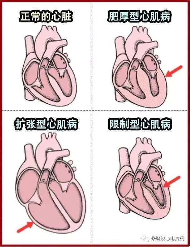 心脏扩大与肥厚(ppt)