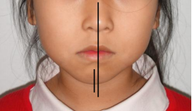 迎春节 送健康|哈医大一院口腔专家提示:儿童牙齿不齐,需要及时矫治!|