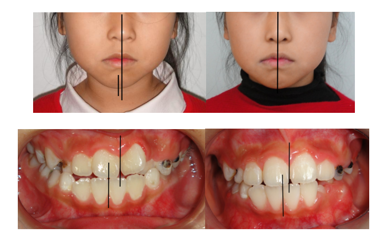 迎春节 送健康|哈医大一院口腔专家提示:儿童牙齿不齐,需要及时矫治!