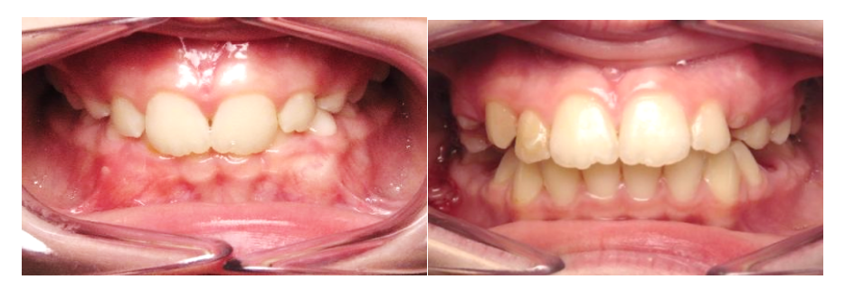 牙弓不对称儿童早期矫治的矫治器有哪些呢?