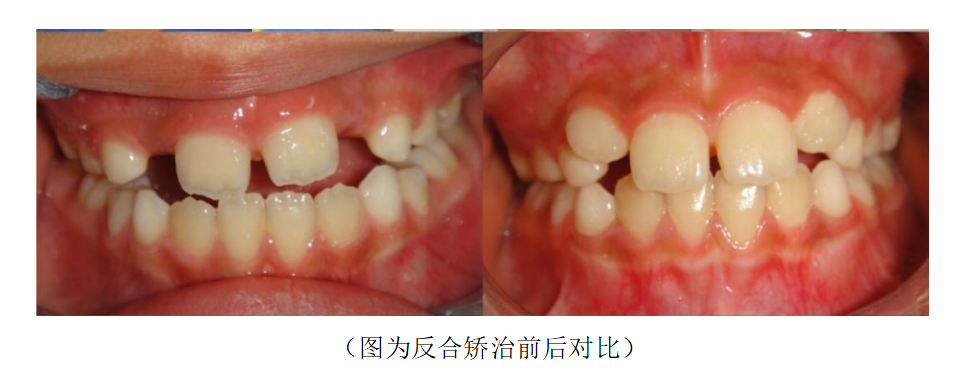 迎春節 送健康|哈醫大一院口腔專家提示:兒童牙齒不齊,需要及時矯治!