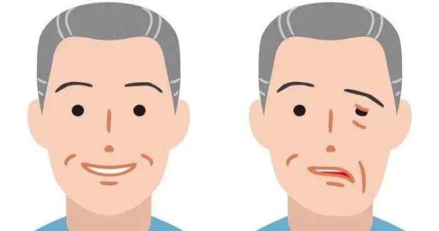 国医大师刘祖贻:治疗中风后遗症经验