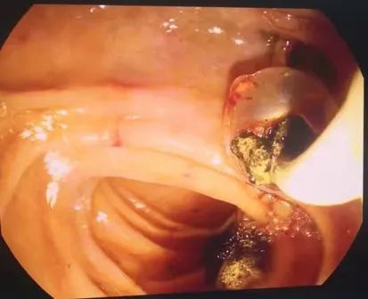 普外科采用ercp超微创为患者解除胆总管结石