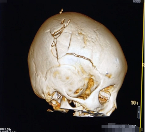 寒假女童不慎跌落颅骨碎裂专家提示假日尤需关注儿童安全