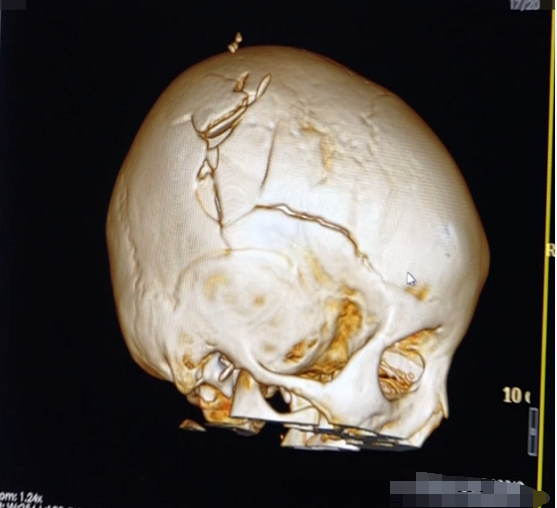 儿童颅骨骨折图片