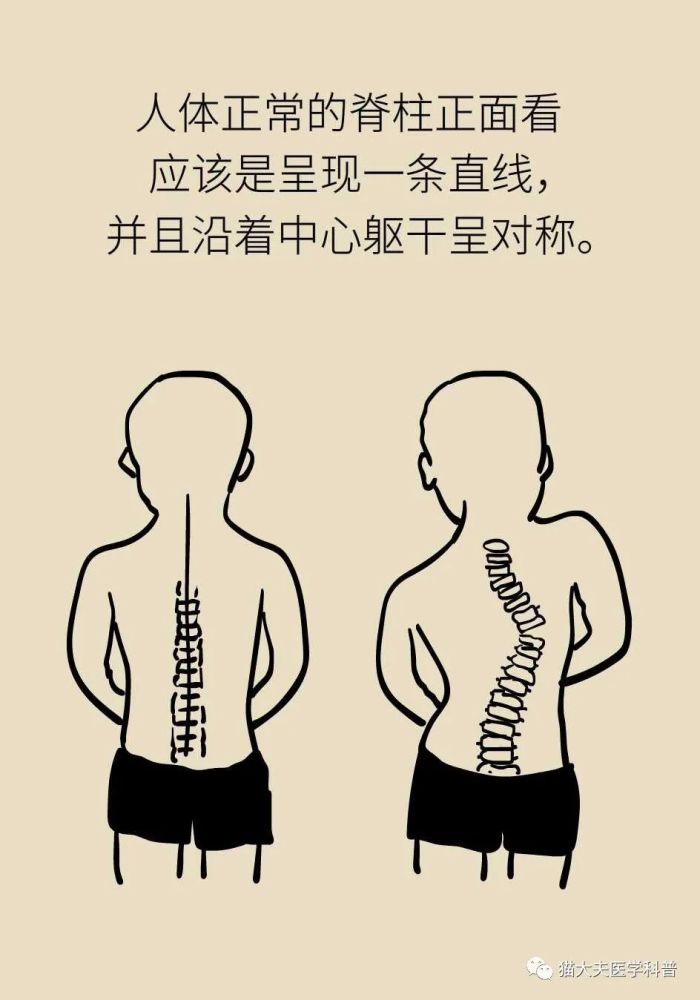 脊椎侧弯 腾讯网