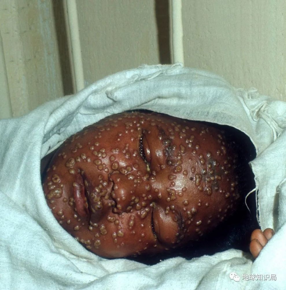 还有些时候,天花病毒可以在组织层或皮肤深层造成严重破坏,患者在出现