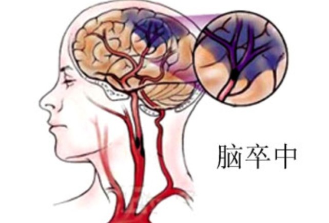 寒潮来袭小心卒不及防专家教您如何预防脑卒中
