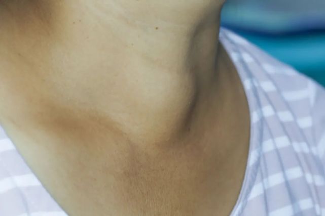 80的女性一生会得一次的甲状腺结节你需要好好了解下
