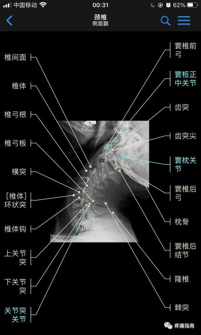 3,棘突,4,横突(本例4,5钩椎关 节不对称)下位颈椎与上位胸椎x光片(1