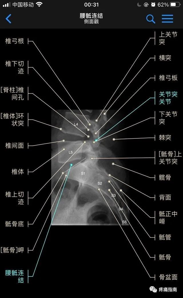 頸椎正位x線片(1,鉤椎關節,2,第三頸椎椎體,3,棘突,4,橫突)(本例4,5鉤