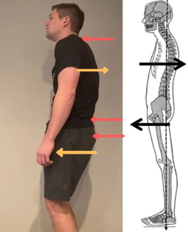 後襬體態指以胸部和肩膀後傾,下巴突出,骨盆突出超過腳踝垂直線,並
