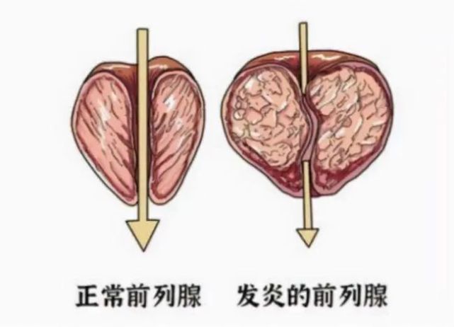 男人的痛患上慢性前列腺炎怎麼辦