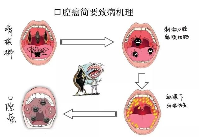 吃槟榔会得什么病图片图片