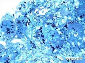 图3 六胺银染色更清楚地显示隐球菌.