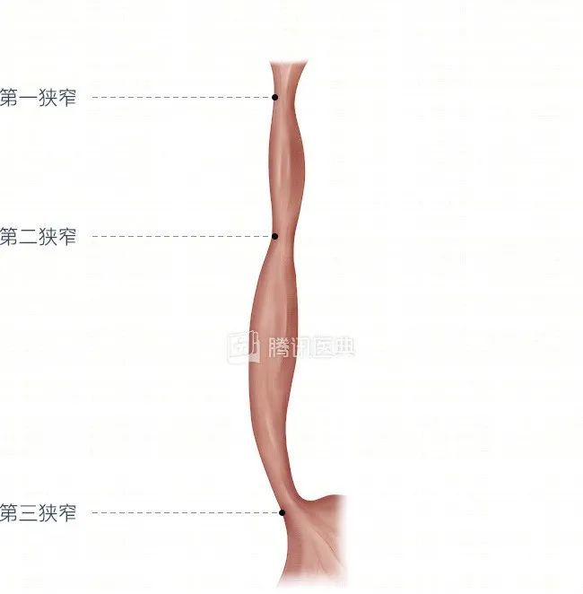 食管三处狭窄图片
