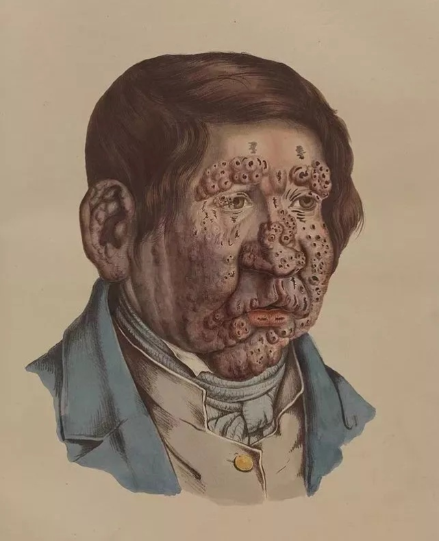 麻风早期表现复杂如何防范漏诊误诊