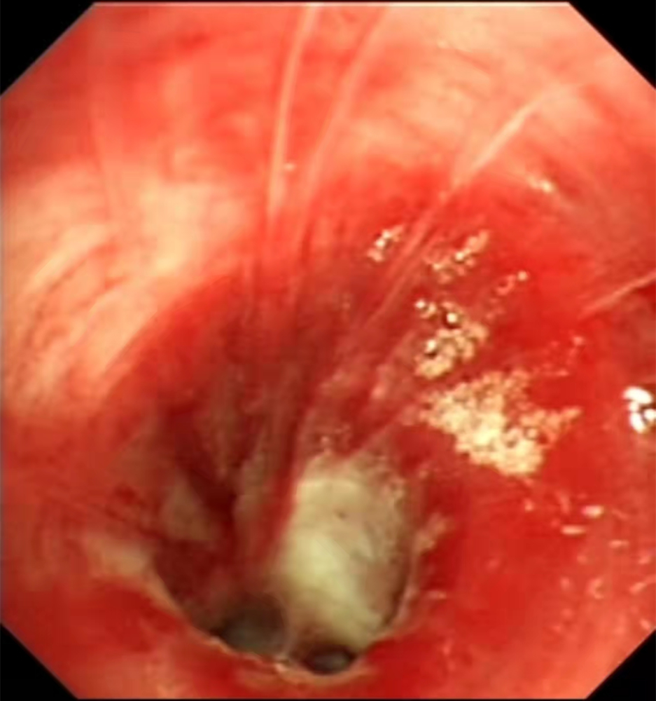 豪爽喝酒也能伤到肺吸入性肺炎如何预防