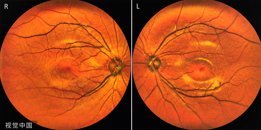 到眼科检查,通过眼底镜可以看到眼底血管是否有硬化,有无动静脉压迫