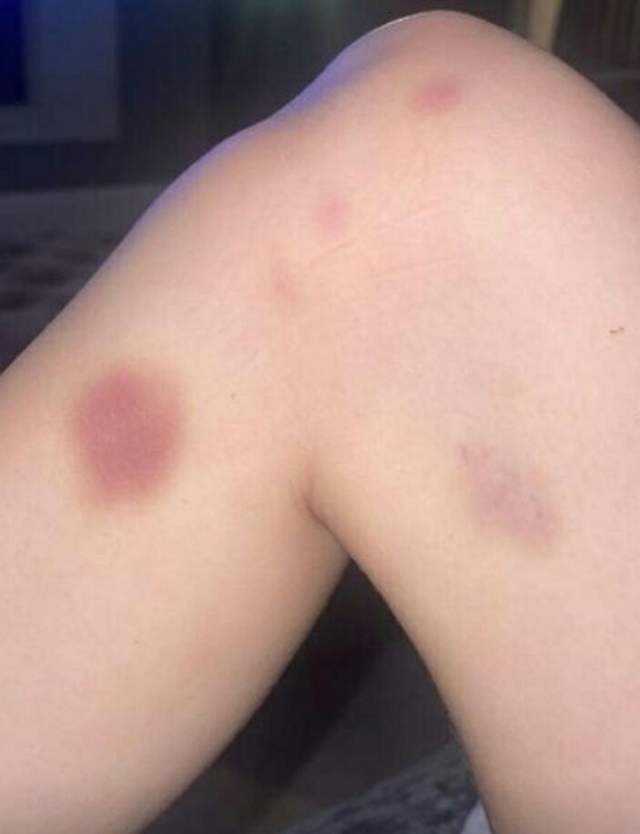 家暴男格林伍德女友称遭到对方殴打嘴角流血身上有多处淤青