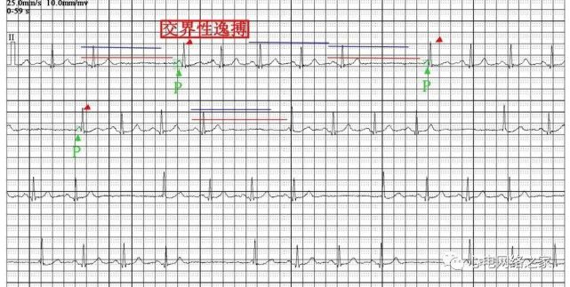 心電圖圖例分析51:竇性停搏,交界性逸搏伴干擾性房室脫節