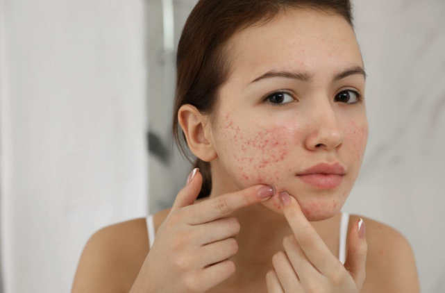 秋天戴口罩的地方反复长痘?手把手教你修复口罩痘脸