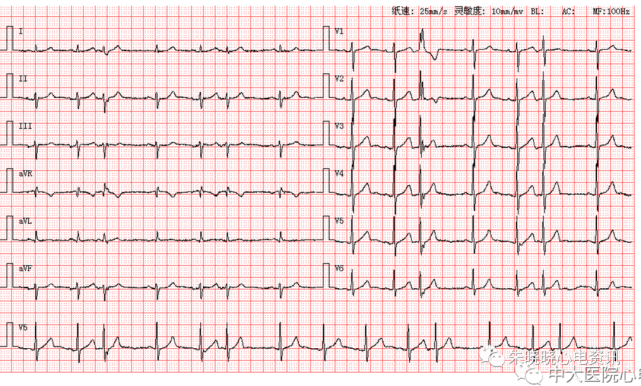左前分支阻滞心电图图片