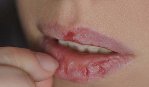 地舔舐嘴唇,口角,导致唇部炎症,出现皮肤干燥,脱屑,红肿,疼痛等症状