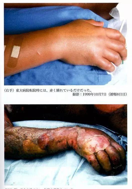 1999年日本大内久遭遇最强核辐射,强行救治83天,看着