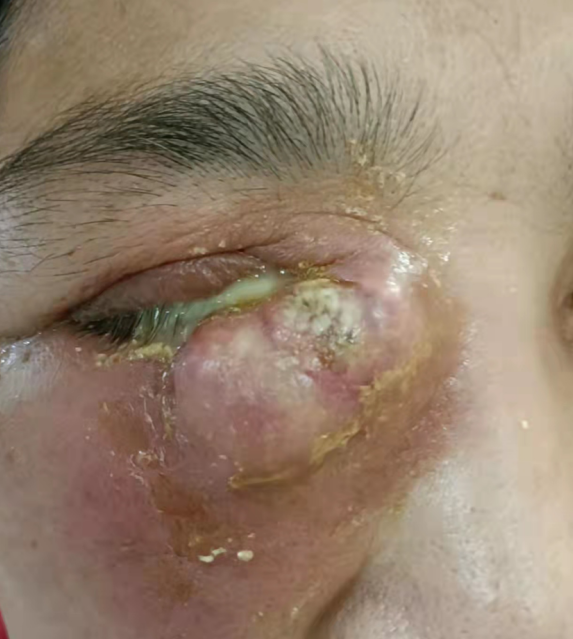 50岁阿姨眼睛肿成"馒头",急性泪囊炎原来这么可怕?