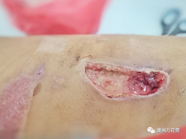 澳洲食肉菌传播原因找到了专家负鼠是细菌库