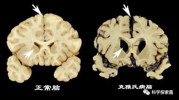 小学智力题产量库鲁病致死率预计恐怖威胁分食同类