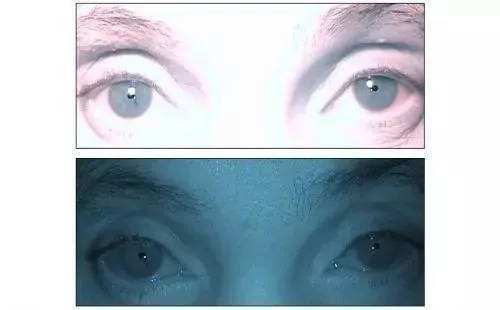 瞳孔缩小至针尖大小,一般提示脑干部分的桥脑有了病变,再就是中毒