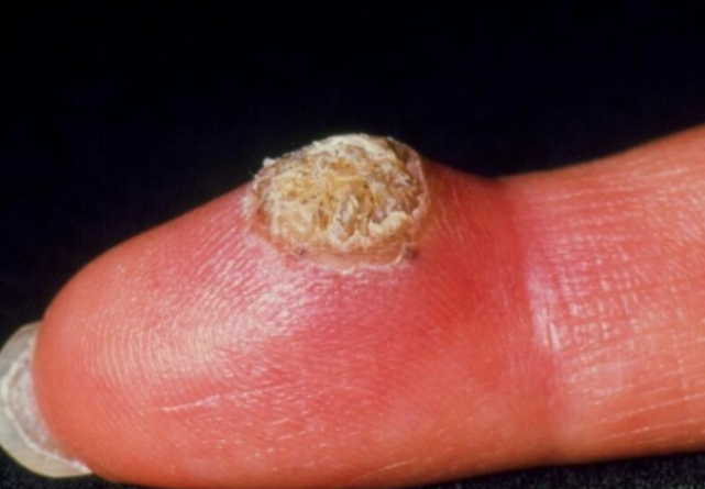 妇科医生:多留意身边这2种人,十有八九是hpv携带者,一眼就能看出来